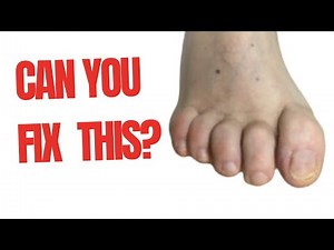hammer toes? 3 recommended rehab exercises to fix