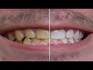 HOW TO GET RID OF YELLOW TEETH STEP BY STEP GUIDE