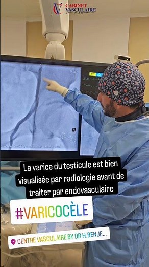 Varicoceles: effective treatment without surgery