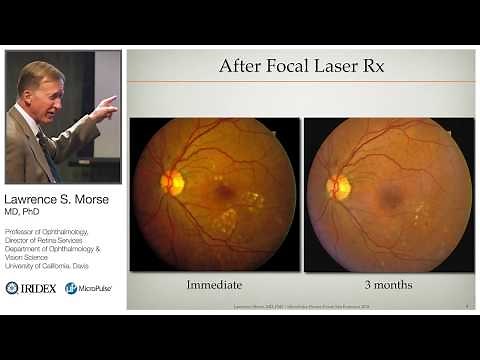 Management of Diabetic Macular Edema with MicroPulse Laser Therapy