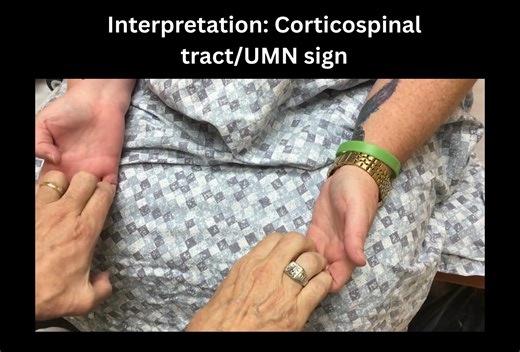 86K views · 622 reactions | 易Wartenberg’s thumb adduction sign易...