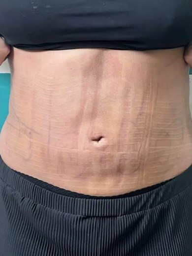 🔥 Tummy Liposuction Before & After Transformation | Amazing Fat Removal Results
