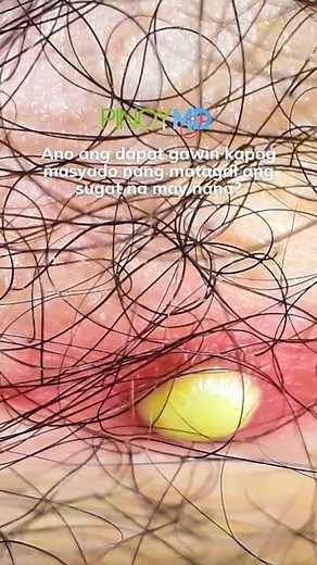 Ano ang dapat gawin kapag masyado nang matagal ang sugat na may nana? ...