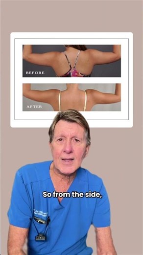 Arms Lipo Before and After