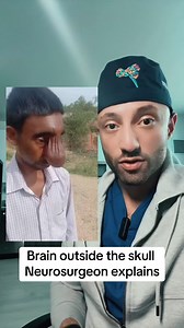 Encephalocele is a skull defect with brain matter outside of the skull. #neuro #pregnancy #folate #brain #doctor #medical | Dr.Z Neurosurgery