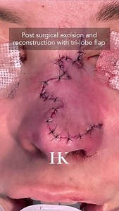 Mole/Scar Removal Via Excision