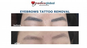 Eyebrows tattoo removal Tattclear Laser Tattoo Removal @Medico Global Clinic Manila - Medical and Skin Care Our team comprises highly trained medical professionals with extensive expertise in laser tattoo removal, dedicated to achieving optimal results while minimizing the inherent risks of tattoo removal, particularly in delicate areas such as the eyebrows. #realpatients #tattclear Tattclear Manila- Laser Tattoo Removal Clinic www.tattclear.com Medico Global Clinic Tattclear - laser tattoo remo