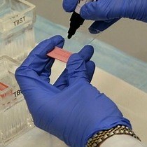 Video: Immunohistochemical Staining of B7-H1 PD-L1 on Paraffin-embedded Slides of Pancreatic Adenocarcinoma Tissue