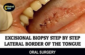 EXCISIONAL BIOPSY: Lateral border of the tongue Step by Step