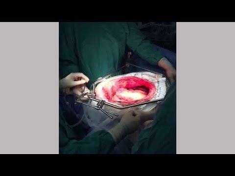 Treatment of peritoneal carcinomatosis | Cecova TV