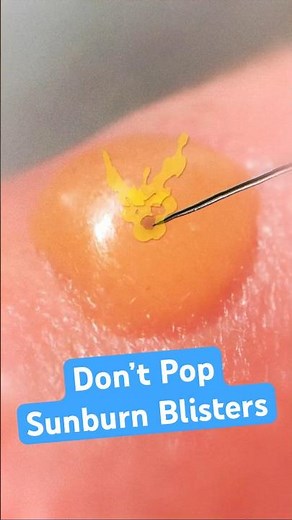 Don't pop sunburn blisters