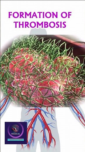 Formation of Thrombosis | 3D Medical Animation |