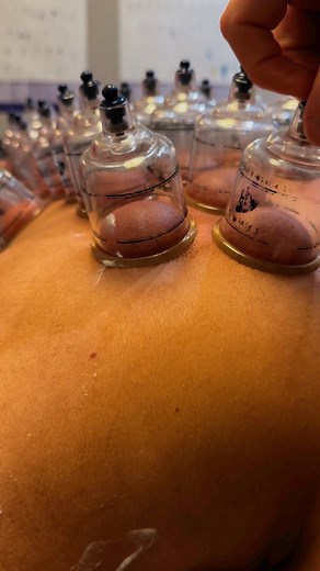 Dr. Kyle Ross on Instagram: "🏆 Cupping therapy uses suction to lift tight muscle and fascia, increase blood flow, and release built-up tension. It’s perfect for sore, overworked areas and faster recovery. 💨💪 #CuppingTherapy #DrKyleRoss #ChicagoChiropractor"