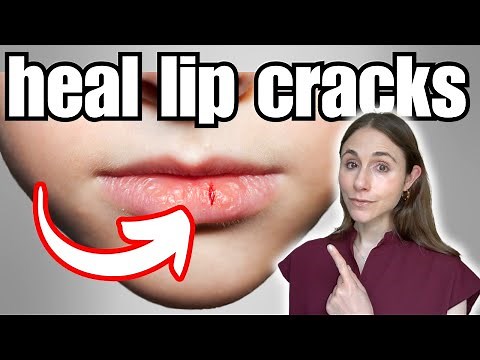 How To Heal Dry, Cracked Lips FAST