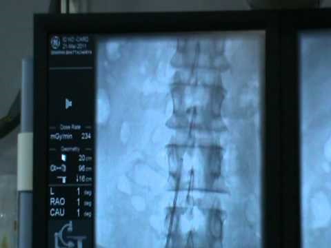 Vascular Intervention: IVC Filter: The Technique