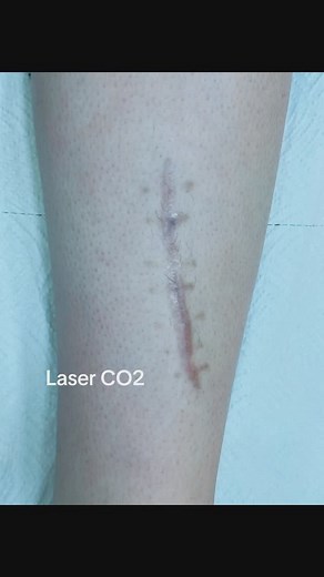 Traitement des cicatrices au laser CO2 | Dermatologue Cheraga - Dr. ZAMOUCHE
