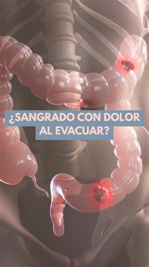 🚨 El cáncer de colon no aparece de la nada. Da señales meses, incluso años, antes… pero muchos deciden ignorarlas. Sangrado, dolor abdominal o cambios en evacuaciones no son normales. Una colonoscopia a tiempo puede prevenir una enfermedad mortal. ✨ En Endoscopia Tijuana te atendemos sin listas de espera y con diagnóstico oportuno. 📲 66 43 75 61 62 (wa.me//6643756162)
