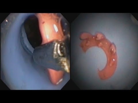 Throat Foreign Body Removal Of !! গলায় আটকে যাওয়া বস্তু বের করা হলো #BD_ENDOSCOPY