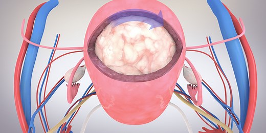 Laparoscopic Myomectomy - TVASurg - The Toronto Video Atlas of Surgery