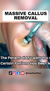 WOW, massive callus removal with gouge By Miss Foot Fixer Marion Yau #missfootfixer #footcallus #footcallusremoval #footcallusremover | Miss Foot Fixer