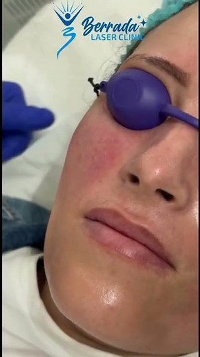 Traitement Rosacée au Laser Fotona