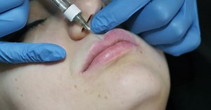 Lip Filler Injections, Cosmetic Procedure