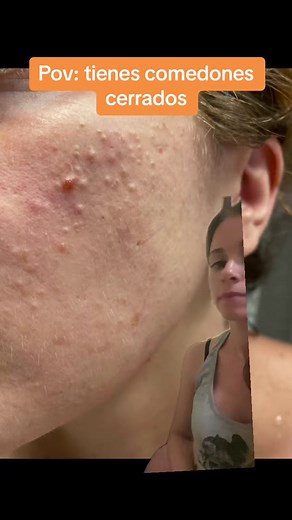 Poros tapados y comedones cerrados: Rutina para combatir el acné