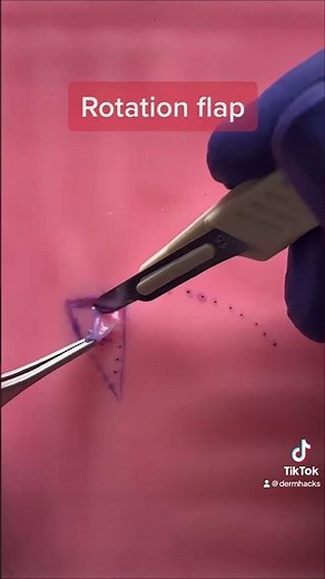 Rotation flap: incision