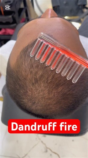 Remove Dandruff Now: Best 5 Treatments That Work Fast-#shorts #youtubeshorts