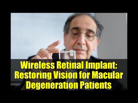 Wireless Retinal Implant: Restoring Vision for Macular Degeneration Patients