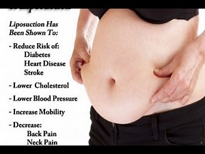 What Are The Benefits of Liposuction? Liposuction Expert Speaks, Trevor Schmidt