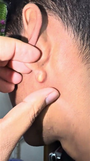 Sebaceous cyst