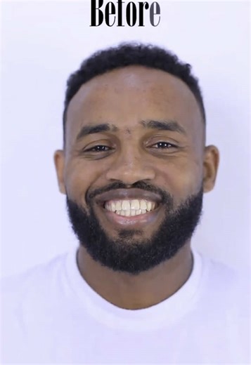 📞0967848919 ጥርሶን ንጣት እና ውበት 3'ቀን ጊዜ የመልሱ [ LANBENA teeth whitening በመጠቀም የጥርሶን ውበት ይመልሱ በ ፍሎራይደ የተጠቃ በሱስ የበለዘ እና የጠቆረ ቢጫ ሆኖ ለቀር በጥርስ ምክንያ ለሚመጣ የአፍ ሽታ ፍቱን መፍትሄ #teethwhitening #lanbenaproducts #lanbenateethwhitening #yellowteeth #ለበለዘጥርስ #የጥርስህክምና #የጥርስማንጫ