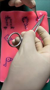 9 flaps comparison (part 6): cheek advancement flap (suture) | Dermhacks