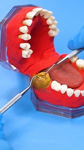 52K views · 68 reactions | Teeth removal by professional dentists | 5-Minute Recycle | Facebook