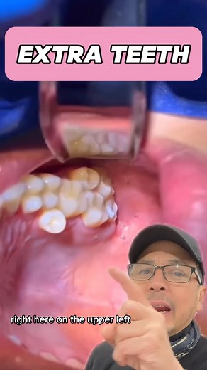 Should You Remove Your Extra Tooth? Dentist EXPLAINS | View Mobile Dental #shorts