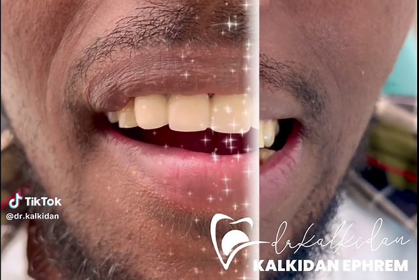 Smile Makeover Procedure: 5 unit zirconia bridge Cost : priceless Book your appointment 📞