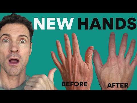 My Hand Filler Before & After: Was It Worth It?