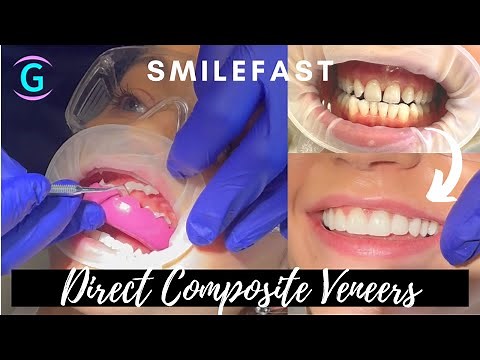 Composite Veneers For Gaps | TASHA'S SMILEFAST TRANSFORMATION!