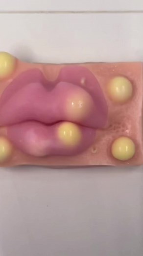 Lips acne removal mochi pimple poppimg satisfying asmr video Satisfying?? #asmrsounds #asmr #viral #fypシ #relax #skincare #mouthsounds #satisfying #tingles #asmrtriggers #mochipimplepopping #pimplepoppin #acnetreatment #asmrtiktoks #asmr_tingles #asmrvideo #lips