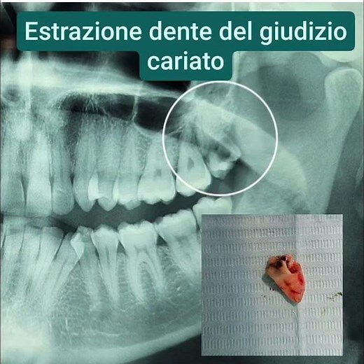 estrazione dente del giudizio cariato #ortodonziabari #dentedelgiudizio