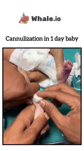 Ak Nursing Academy on Instagram: "Cannulization (or cannulation) is the medical procedure of inserting a cannula, a thin tube, into a hollow body part like a vein, artery, or organ, to provide access for fluids, medication, blood draws, or drainage, common in IV lines for hydration/drugs, or specialized procedures like arterial access or even dentistry. It involves selecting a site (like an arm vein for IVs), inserting the cannula carefully (often at an angle until blood appears), and securing i