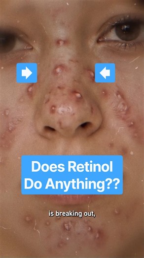 Does retinol DO anything??