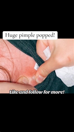 Effective Cyst Drainage Techniques for Relief