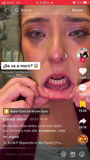 Candidiasis oral🍄 . #candidiasisoral