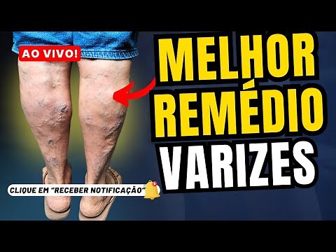 O MELHOR remédio para VARIZES, vasinhos, veias entupidas, varicoses - Elimina a MÁ CIRCULAÇÃO