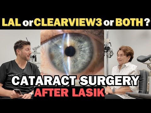 Cataract Surgery after LASIK | Combining the LAL & Clearview 3 | Surgery & Patient Interview