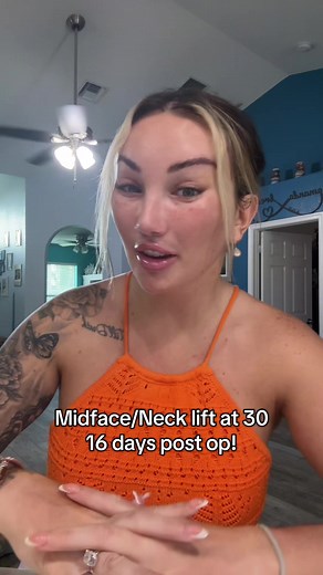 16 Days Post Neck and Midfacelift Surgery