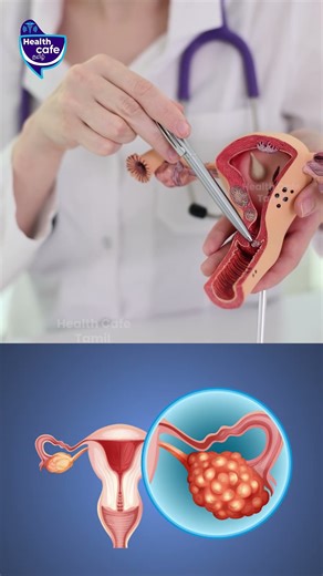 PCOD வருவதற்கு இதுதான் காரணம்! | Health Cafe Tamil | Tips | Dr Akshayan