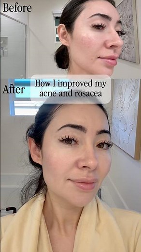 Red Light Therapy for Acne and Rosacea (the results speak for themselves!)